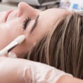 Chemical Peels: Understanding the Medical Spa Procedure