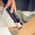 Tattoo Removal Treatments: What You Need to Know