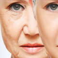 Wrinkle Reduction Treatments: An Overview