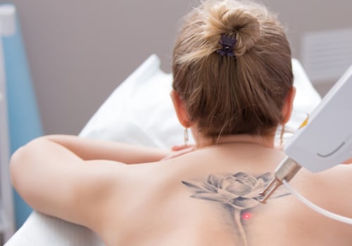 Tattoo Removal Treatments and Procedures