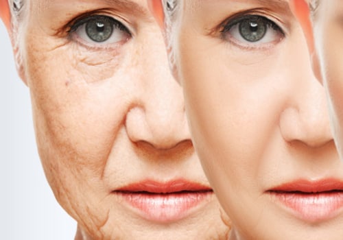 Wrinkle Reduction Treatments: An Overview