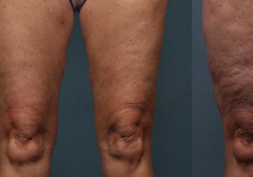 Cellulite Reduction Treatments